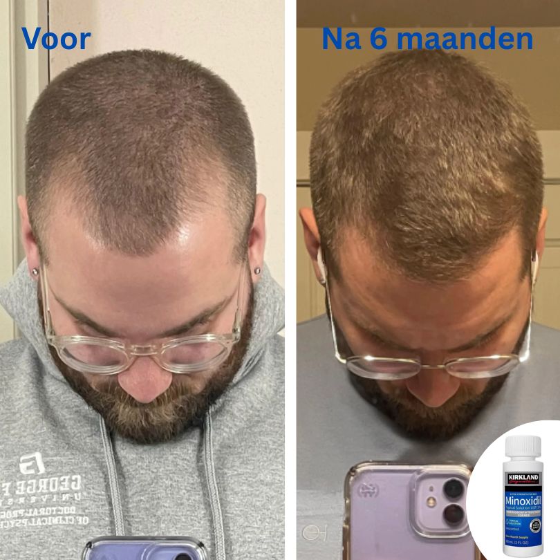 Kirkland™ Minoxidil 5% – Voor Sterker, Dikker & Vol Haar