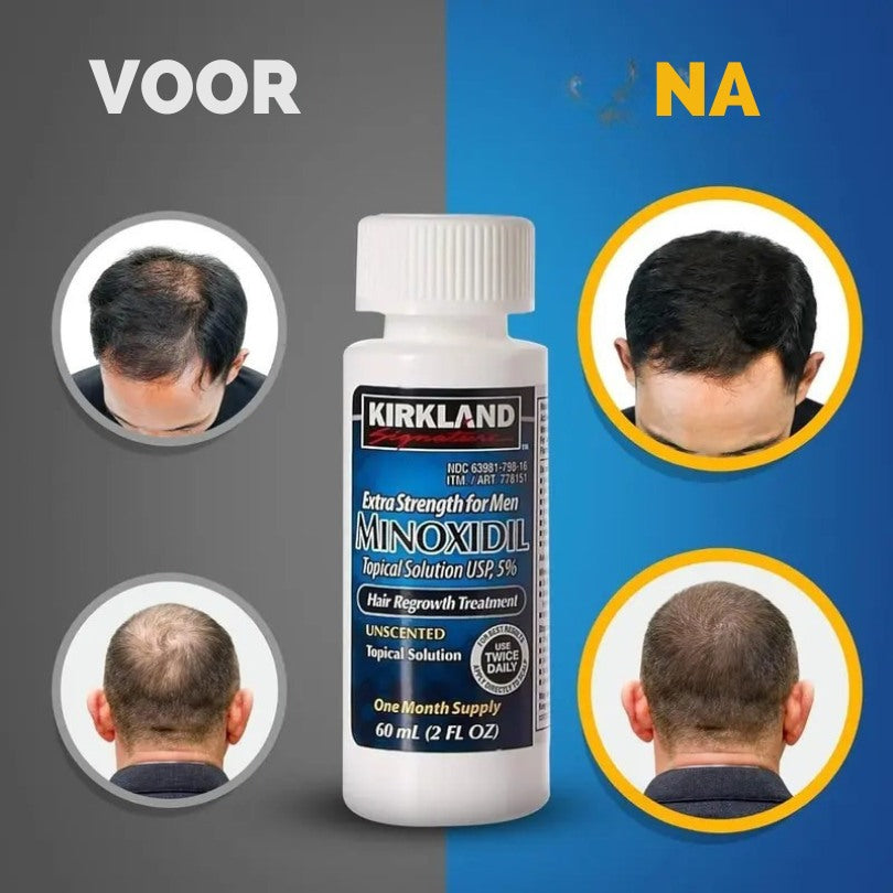 Kirkland™ Minoxidil 5% – Voor Sterker, Dikker & Vol Haar