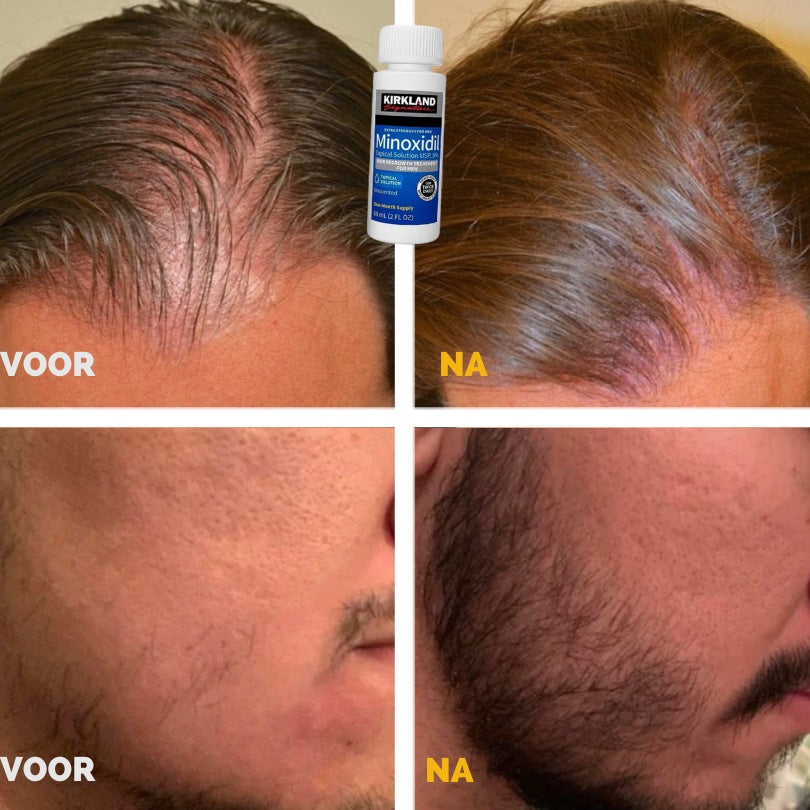 Kirkland™ Minoxidil 5% – Voor Sterker, Dikker & Vol Haar