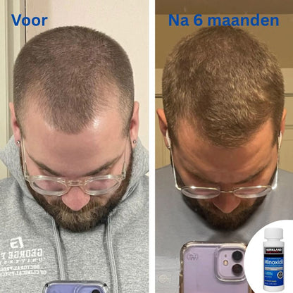 Kirkland™ Minoxidil 5% – Voor Sterker, Dikker & Vol Haar